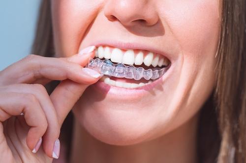 close up of woman using clear aligners