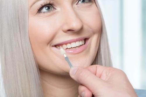 lihue woman getting veneers