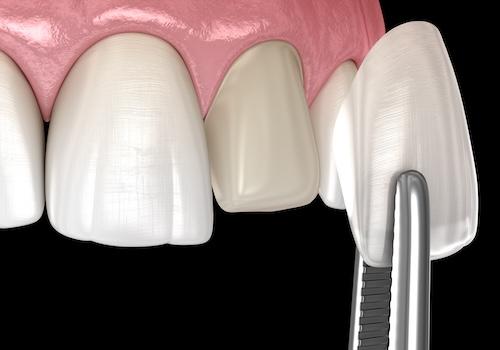dental veneers