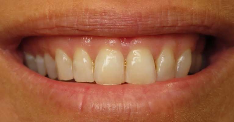 Clear-Aligners-After-Image