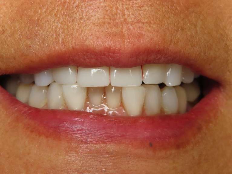 even smile after dental crowns