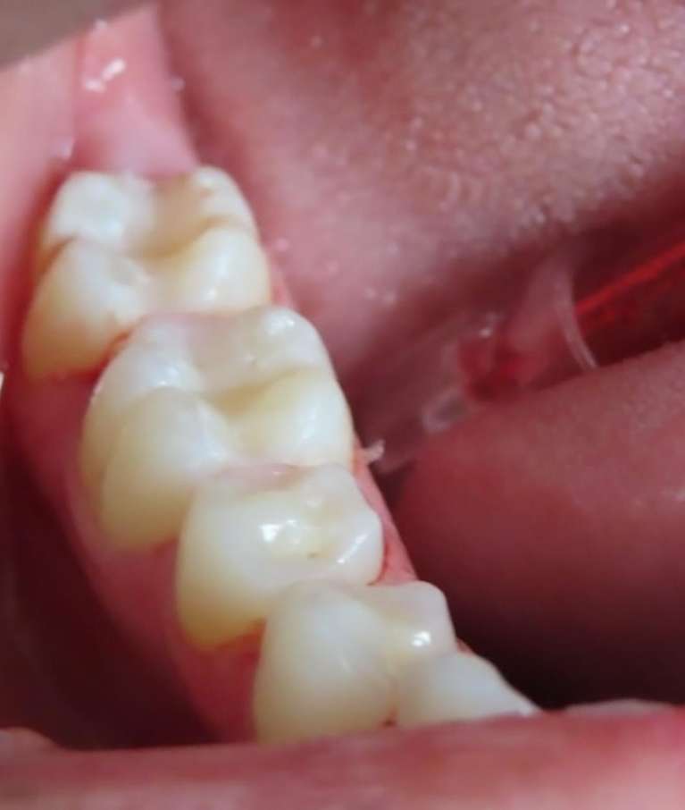 back teeth after tooth-colored fillings