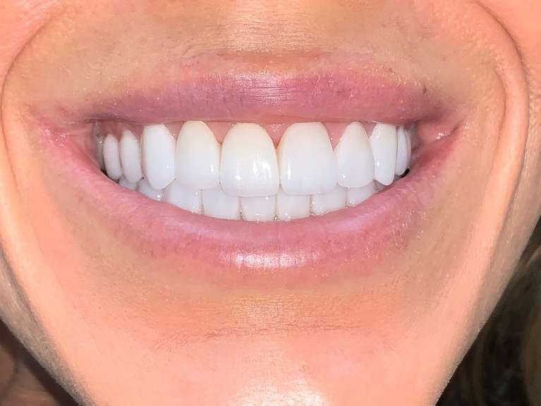 Full-Mouth-Rehabilitation-After-Image