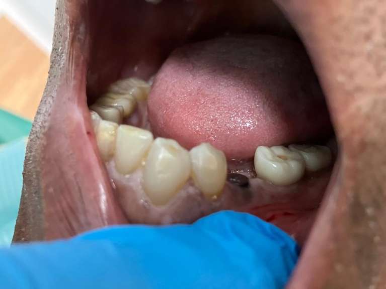 dental implant