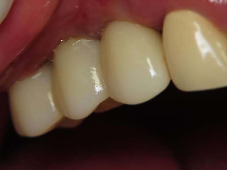 implants after crown has been added