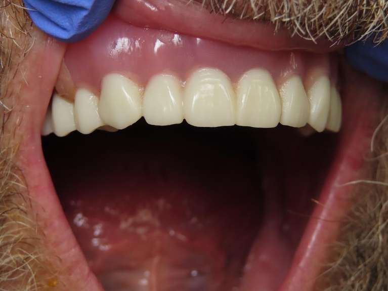 Implant Retained Denture