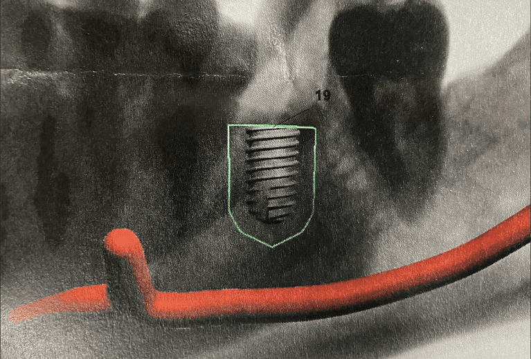 xray of tooth after dental implant