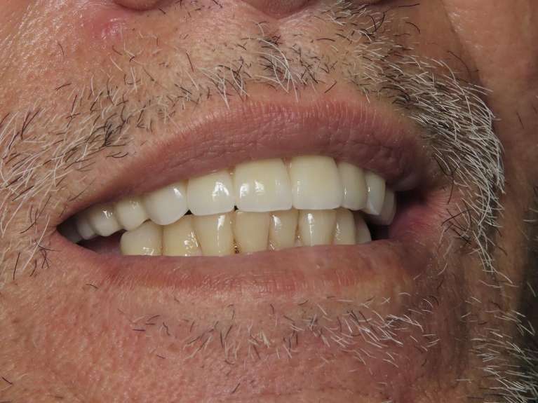 Implant Retained Fixed Hybrid Teeth