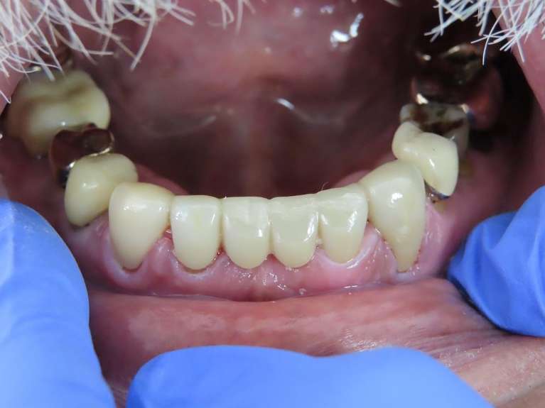 Mandibular-Bridge-After-Image