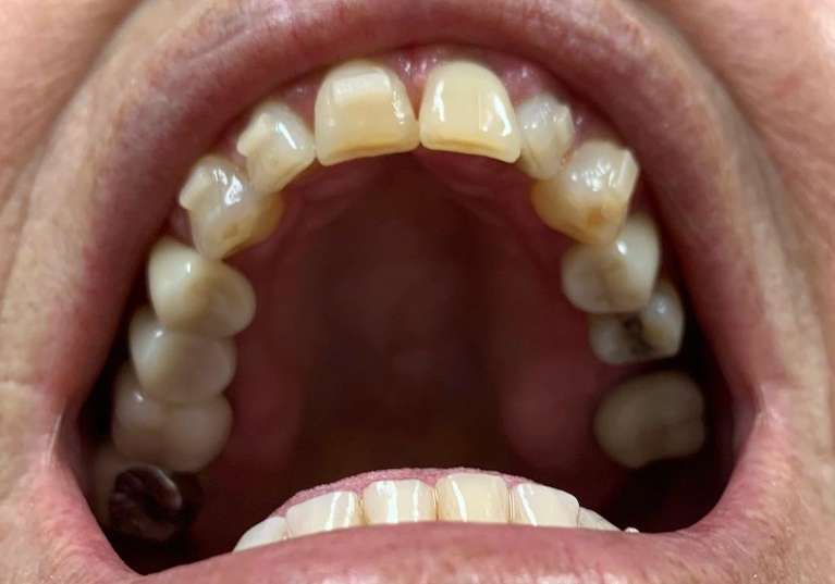 Diastema-Closure-After-Image