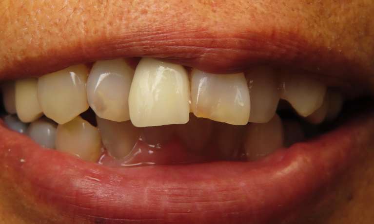Aesthetic-Crowns-Before-Image