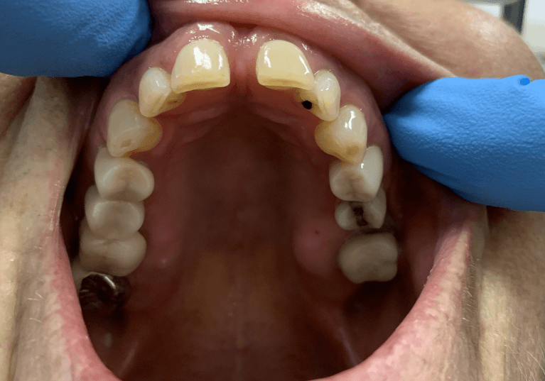 Diastema-Closure-Before-Image