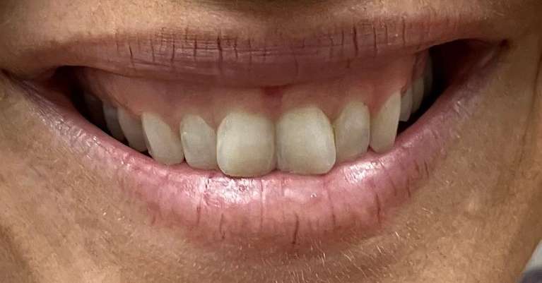 Clear-Aligners-Before-Image