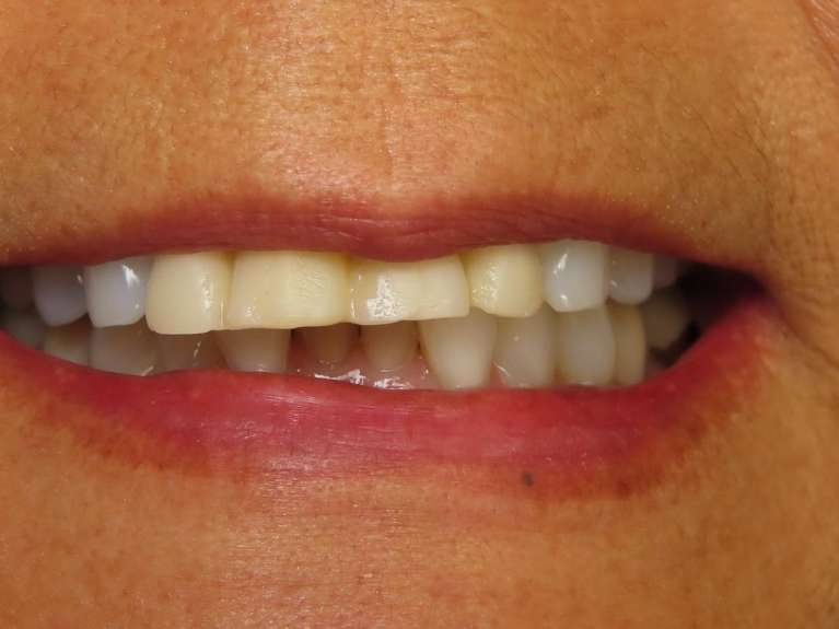discolored teeth before new crowns