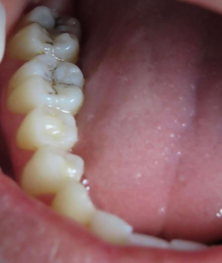 back teeth before fillings
