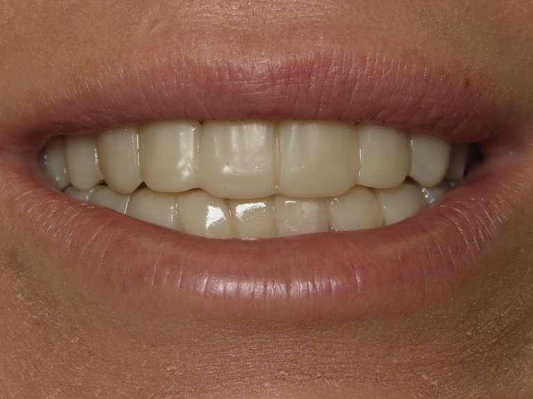 Full-Mouth-Rehabilitation-Before-Image