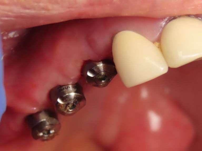 dental implants before crowns