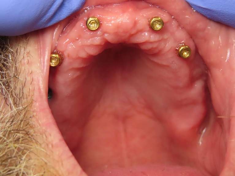 mouth with implants before adding implant supported dentures