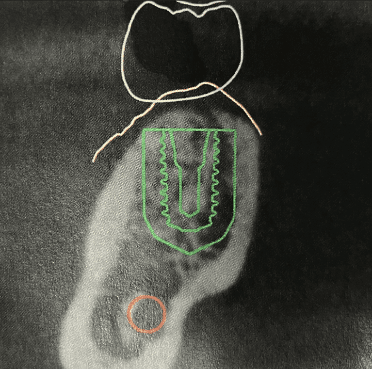 xray of jaw before dental implant