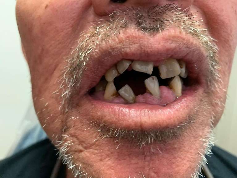 broken and missing teeth before implants