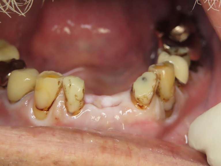 Mandibular-Bridge-Before-Image