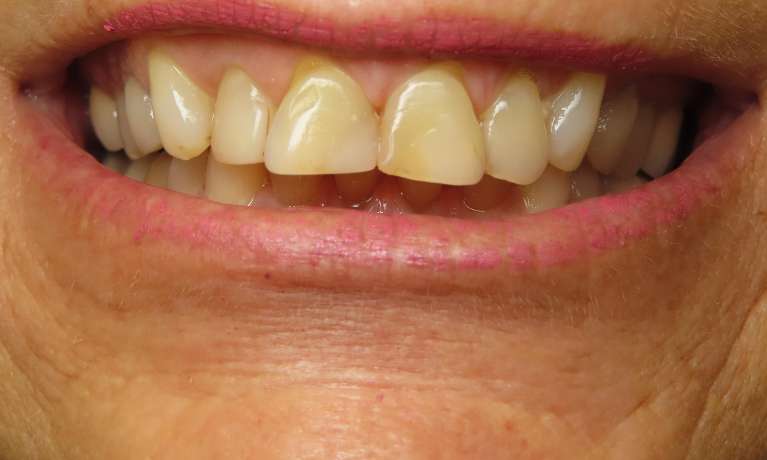 Smile-Rehabilitation-Before-Image