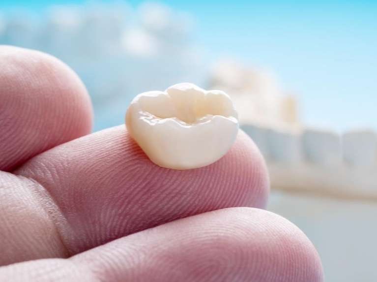 Same-Day Dental Crowns